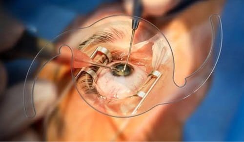 Cataract Surgery